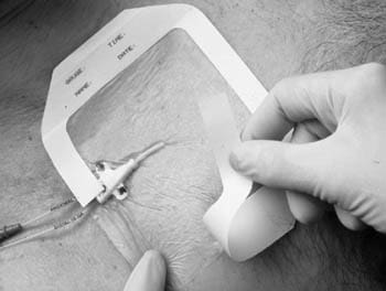 A person is putting a bandage on a patient's chest.