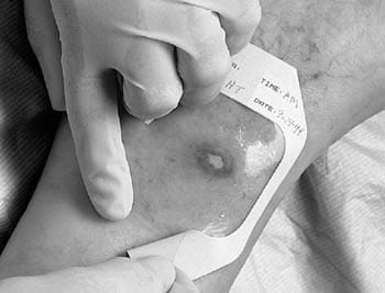 A person is putting a bandage on a patient's leg.