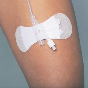 A woman's leg with an iv drip attached to it.