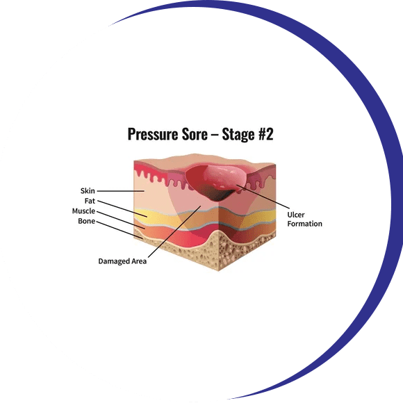 A cross section of the skin shows how pressure sores are formed.